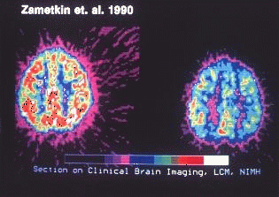 An early PET scan study found that global cerebral glucose metabolism was 8.1% lower in ADHD patients. The image on the left illustrates glucose catabolism in the brain of a person without ADHD while doing an assigned auditory attention task. The image on the right illustrates the areas of activity of the brain of someone with ADHD when given that same task.