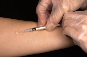 Mantoux tuberculin skin test.