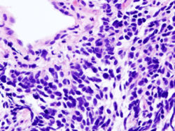 Lung small cell carcinoma (microscopic view from a core needle biopsy)